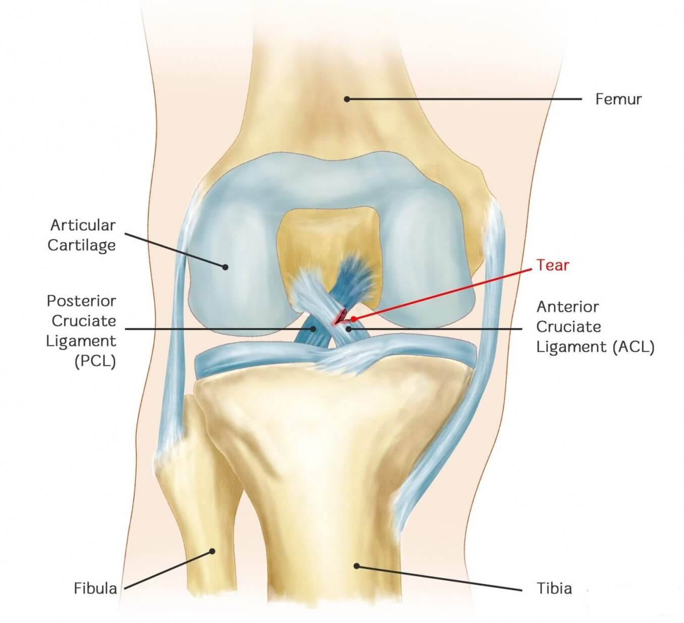 ACL Injury